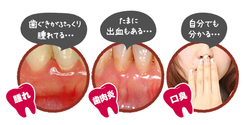 歯茎の腫れ、歯肉炎、口臭予防に役立つため、口腔内のトータルケアが可能