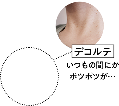 デコルテ　いつの間にかボツボツが…