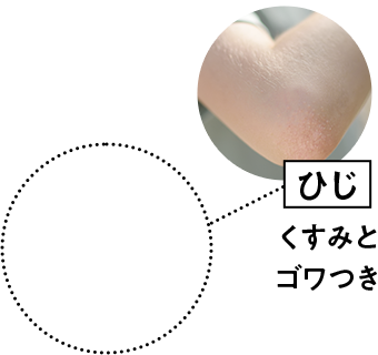 ひじ　くすみとゴワつき