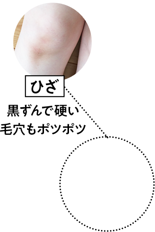 ひざ　黒ずんで硬い　毛穴もボツボツ