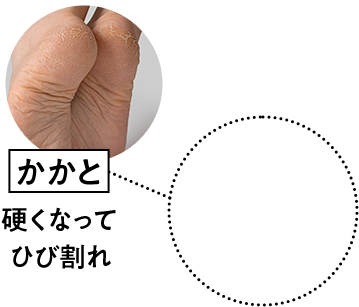 かかと　硬くなってひび割れ