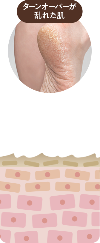 ターンオーバーが乱れた肌の動画　ごわごわカサカサ